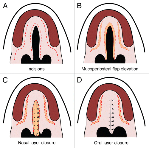 Figure 4 Von Langenbeck palatal repair. (A) Secondary cleft palate palate with dotted red lines demonstrating incisions. (B) Mucuoperiosteal flap elevation with orange demonstrating opening of the incisions. (C) Midline nasal closure of the defect with the nasal layer in orange. (D) Closure of the midline incision with the oral mucosa over the nasal layer closure.