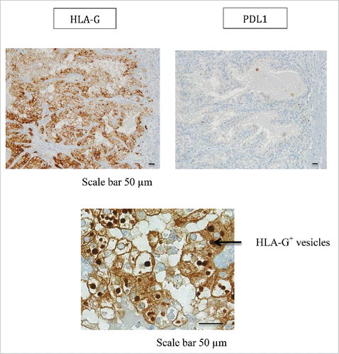 Figure 5. Representative staining obtained by immunohistochemistry analysis for PDL1 and HLA-G expression in tumor area (T1) from patient #2 is shown. Formalin-fixed tumor tissue sections from the tumor area T1 were stained with antibody directed either against PDL1 or HLA-G marker. Brown labeling indicates marker positivity. HLA-G staining is observed in the cytoplasm of tumor cells but also in intracellular and extracellular vesicles. Scale bars are indicated.