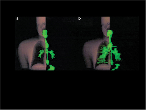 Figure 3. PET images of triamcinolone [11C]acetonide deposition (green color) in the lungs of one healthy volunteer. Triamcinolone [11C]acetonide was administered with a metered dose inhaler without (A) and with (B) the use of a spacer during inhalation. Note the increased deposition in the bronchi and peripheral lung when the spacer was used. This research was originally published in JNM. Marc S. Berridge, Zhenghong Lee, and Donald L. Heald. Pulmonary Distribution and Kinetics of Inhaled [11C]Triamcinolone acetonide. J. Nucl. Med. 2000;41:1603–1611 [Citation59].