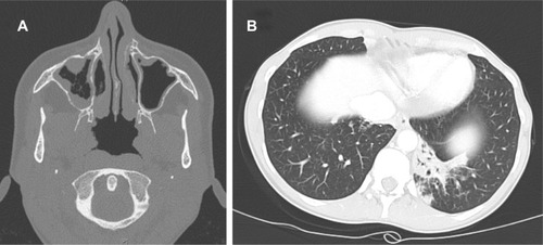 Figure 1 Computed tomography scan revealing a right maxillary sinusitis (A) and left focal basal pneumonia without cavitation (B), due to Actinomyces spp., in an immunosuppressed woman.