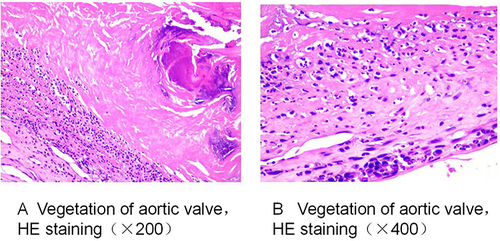Figure 2 Vegetation of aortic valve (HE staining). (A) Vegetation of aortic valve, HE staining (×200). Vitreous degeneration, cellulose like necrosis, calcification, and extensive infiltration of inflammatory cells. (B) Vegetation of aortic valve, HE staining (×400). Inflammatory cells with a large number of lobulated nuclei (neutrophils) and a small number of plasma cells.