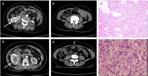 Figure 2. Representative radiographic and histological images of patients. (a-c) Low-T-stage ccRCC in a 49-year-old woman. (d-f) High-T-stage ccRCC in a 54-year-old woman. (a) Enhanced CT showing right renal tumour (white arrow). (b) CT image with a relative visceral fat area (rVFA) of 18.2%. (c) Histologic photomicrograph confirming that the tumour did not involve capsule so as to be T1 stage. (d) Enhanced CT showing right renal tumour (white arrow). (e) CT image with a relative visceral fat area (rVFA) of 35.0%. (f) Histological micrographs confirming that the tumour involved the capsule, but was confined to the perirenal fascia so as to be T3 stage