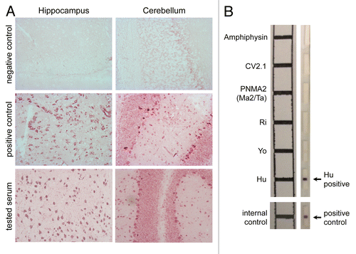 Figure 1. Detection of autoantibodies associated with the anti-Hu syndrome. (A) Patient sera containing Hu-specific autoantibodies specifically recognize neurons in the central nervous system (CNS) (magnification 200 ×). Briefly, hippocampal (left panels) and cerebellar (right panels) rat slices (EuroImmun) were incubated with serum from either an individual not affected by paraneoplastic neurological disorders (PNDs) (negative control), either a patient with a confirmed anti-Hu syndrome (positive control), or a subject suspected to suffer from the anti-Hu syndrome, followed by the detection of bound IgG using biotinylated goat anti-human IgG, ABC and VIP kits (Eurobio). The test serum turned out to contain anti-neuron antibodies exhibiting a staining pattern compatible with that of anti-Hu antibodies. (B) The molecular identification of the specificity of such neuron-specific IgGs is made by immunoblotting-based diagnostic tests. Patient-derived serum (1/100 dilution) and cerebrospinal fluid (when available) are incubated on a membrane stripped (right panel) with paraneoplastic neurological syndrome-associated antigens, including amphiphysin, CV2, PNMA2 (Ma2/Ta), Ri, Yo, and Hu proteins (EuroImmun). Upon washing, bound IgGs are detected using alkaline phosphatase-conjugated anti-human IgG antibodies and their position is confronted to a reference scheme.