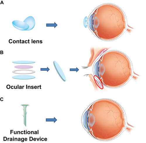 Figure 3 The application of nanotechnology to ophthalmic devices. The sustained release of drug through (A) contact lens and (B) ocular insert. (C) The coating of functional drainage device.