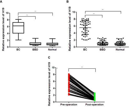 Figure 2 (A). The levels of exosomal H19 were 6.225 (2.133–8.167) in BC patients, 0.905 (0.465–2.532) in BBD patients, 0.875 (0.431–2.374) in healthy subjects. There were significant differences in the levels of H19 across the groups (BC vs BBD, P < 0.001; BC vs healthy subjects, P < 0.001). (B) The expression levels of exosomal H19 was signiﬁcantly increased in BC patients than in BBD and in healthy controls. (C) Level of exosomal H19 in the serum of patients with BC varied across pre-operation samples and those after 7 days of tumor resection (post-operation); ***P < 0.001, n=50 per group.