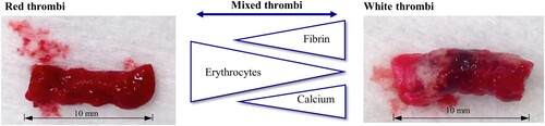 Figure 2. Thrombus types and their compositions. From red to white thrombi with increasing or decreasing amounts of fibrin, erythrocytes and calcium.