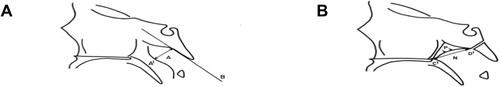 Figure S1 (A) Adenoidal measurements. “A” represents distance from A1 point of maximal convexity, along inferior margin of adenoid shadow to line B,drawn along straight part of anterior margin of basiocciput. “A” is measured along line perpendicular from point A1 to its intersection with B. (B) Nasopharyngeal measurement. “N” is distance between C1 posterior superior edge of hard palate, and D1, anteroinferior edge of sphenobasiocciptal synchondrosis. When synchondrosis is not clearly visualised, point D1 can be determined as site of crossing posteroinferior margin of lateral pterygoid plates P and floor of bony nasopharyndx.Note: Reprinted from Radiographic evaluation of adenoidal size in children: Adenoidal-nasopharyngeal ratio. Am J Roentgenol, Fujioka M, Young LW, Girdany BR, the American Journal of Roentgenology 133(3), Copyright© 1979, American Roentgen Ray Society.Citation52