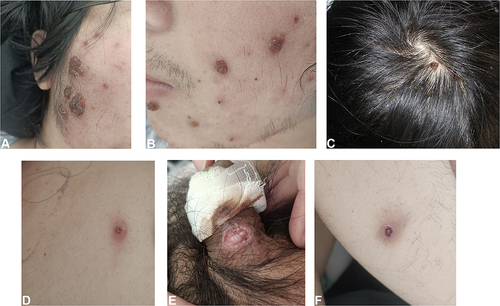Figure 1 (A–C) multiple erythematous papules/ plaques covered with crust on the scalp and face ranging from 0.5 to 1.5cm. (D) an erythematous papulovesicle on the abdomen. (E) single oval, 1cm-sized, sharply demarcated ulcer located on the penis. (F) an erythematous ulcer on the right calf.
