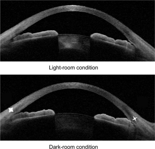 Figure 2 Anterior-segment optical coherence image in one meridian. Iridotrabecular contact was found in the dark-room condition (white stars).