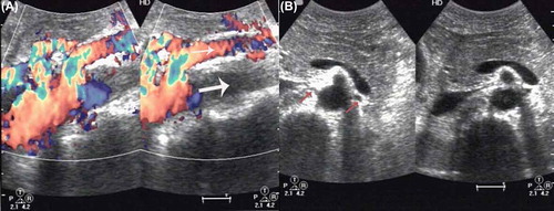 Figure 2. (A) Abdominal color Doppler ultrasonography showing an echo filling (thin arrow) at the double renal artery level of the abdominal aorta and superior mesenteric artery, widened diameter (thick arrow) with increased velocities (PS 208 cm/s). (B) The intima media thickness at bilateral renal artery opening (arrows) was found; the diameters of the arteries were significantly reduced.