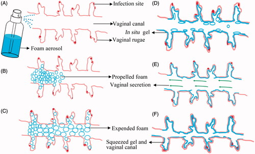 Figure 6. The schematic illustration of the expansible thermal gelling foam aerosol during foam expansion, thermal gelation and gel retention. (A) the ETGFA is administrated as foam aerosol; (B) the foam aerosol is spurted to the vaginal canal by propellant; (C) the foam expands and penetrates to the infectious sites in deep vaginal rugae; (D) the foam thermally transforms into gel to cover the infectious sites on the vaginal mucosa and the gel resists to the self-cleaning during (E) vaginal secretion and (F) vaginal contraction motion.