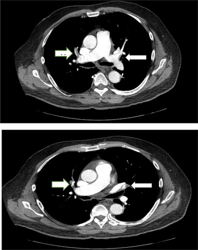 Figure 1. Series of CT scan images with IV contrast indicating bilateral filling defects (arrows).