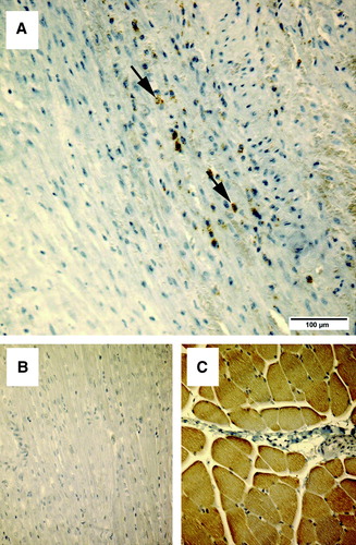 Figure 3.  The upper images (A and B) demonstrate immunostaining for the skeletal muscle-specific nebulin, in samples of the lateral part of the left ventricle, where myoblasts were transplanted. The lower panels (C and D) show specificity controls for the nebulin antibody. The anti-nebulin antibody does not react with myocardium (C), but specifically recognizes skeletal muscle (D).