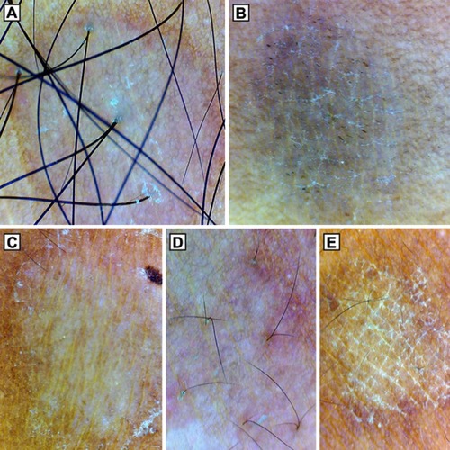 Figure 3 Dermoscopy (original magnification 10×) showing different patterns of scaling in pityriasis versicolor. (A) Patchy scaling in hypopigmented lesion. (B) Diffuse scaling in hyperpigmented lesion with the simultaneous presence of scaling in the furrows. (C) Peripheral scaling. (D) Perifollicular scaling. (E) Scaling in the furrows. Note the nonuniform pigmentation in all the lesions, perilesional hyperpigmentation in (A) and inconspicuous ridges and furrows in (A), (D).