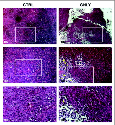 Figure 3. H&E staining in histological sections of MDA-MB-231-derived tumors. Representative images of resected MDA-MB-231-derived tumors from the control group (CTRL) or from the granulysin-treated group (GNLY) of the experiment in Fig. 2A are shown. Paraffin tissue sections were stained with standard H&E coloration, as indicated in Material and Methods. Magnifications were of 40X in the upper panels, 100X in the middle panels and 200X in the lower panels. Squares correspond in each image to the zone that is enlarged below, arrows to the polymorphonuclear infiltrate, and asterisks to the mononuclear infiltrate.