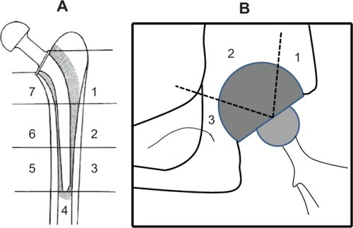 Figure 1 Radiologic osteolysis location according to: (A) Gruen zones and (B) De Lee and Charnley zones.