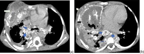 Figure 2 Post-contrast axial chest and abdominal Ct images (a) chest at the level of carina demonstrating multiple peripherally calcified mediastinal LN (blue arrow) and anterior chest wall fluid collection with rim enhancement confirming abscess formation (white arrow), (b) lower chest images, demonstrating necrotic lung tissue with central and marginal calcification (black arrow) small abscess collection extending down is also noted (white arrow) and similar appearing multiple lymph nodes (blue arrow).