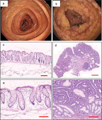 Figure 1. Endoscopic appearance and pathological characteristics of healthy control and FAP. a. The colonoscopy feature of healthy control. b. The colonoscopy feature of FAP. c, e. The pathological characteristics of healthy control (5x magnification, 200x magnification, respectively). d, f. The pathological characteristics of FAP (5x magnification, 200x magnification, respectively).