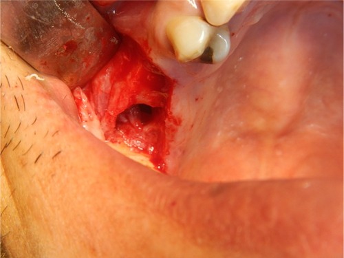 Figure 3 At the site of the first molar, a large bony defect was found after the flap was raised and the bone was exposed.