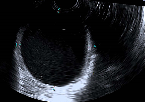 Figure 3 Vaginal ultrasound image showing a dark liquid area (2020.06.03).