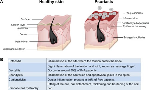 Figure 1 Psoriasis and PsA. (A) Psoriasis is associated with a hyperproliferative epidermal layer, abnormal keratinocyte growth, and an inflammatory cell infiltrate including T cells and macrophages. This manifests in inflamed skin and raised plaques with silvery scales and can cover large areas of the body. (B) Glossary of clinical features associated with classification of psoriatic arthritis. Adapted from Bren L. Psoriasis: more than cosmetic. FDA Consumer. 2004 Sept–Oct. Available from: http://permanent.access.gpo.gov/lps1609/www.fda.gov/fdac/features/2004/504_psoriasis.html. Accessed February 8, 2013.Citation63
