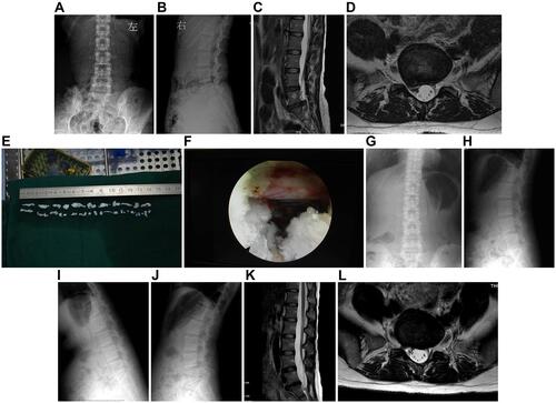 Figure 1 A 37-year-old female had severe sciatica for more than one year due to LDH and was treated by PELD using the transforaminal approach. (A–D) Preoperative X-rays and MR images showed protrusion at the L5-S1 segment. (E, F) Photograph during the operation showed the disc material removed and adequate decompression of the nerve root. (G–L) X-ray and MR images 7 years postoperation showed complete decompression and good preservation of the disc height.