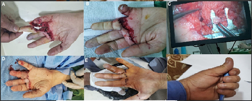 Figure 1 Index and middle fingers amputation and devascularization (A). Bone fixation by K-wires (B). Microvascular anastomosis, two digital arteries, one dorsal vein, and two digital nerves for each finger (C). Post-operative finger appearance (D), on the third postoperative day (E). Showing accepted finger grasp function (F).