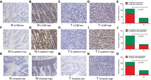 Figure 2 Representative examples of LC3B, E-cadherin, and Vimentin expression (200×).Notes: Low LC3B expression in paired nontumor (A) and GC tissues (C), high LC3B expression in adjacent normal (B) and GC tissues (D), comparisons of LC3B expression in adjacent normal and GC tissues (E), low E-cadherin expression in adjacent normal (F) and GC tissues (H), high E-cadherin expression in adjacent normal (G) and GC tissues (I), comparisons of E-cadherin expression in adjacent normal and GC tissues (J), low Vimentin expression in adjacent normal (K) and GC tissues (M), high Vimentin expression in adjacent normal (L) and GC tissues (N), comparisons of Vimentin expression in adjacent normal and GC tissues (O).Abbreviations: GC, gastric cancer; N, adjacent normal tissue; T, GC tissue.