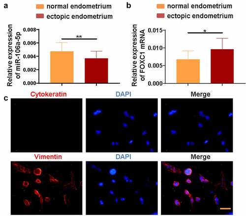 Figure 1. miR-106a-5p was decreased and FOXC1 was increased in endometrial tissues. (a) The RT-qPCR assay demonstrated a decreased level of miR-106a-5p in ectopic endometrial specimens compared with normal endometrial specimens. Student’s t-test, **p < 0.01. (b) FOXC1 mRNA level was increased in ectopic endometrial specimens compared with normal endometrial specimens. Student’s t-test, *p < 0.05. (c) An immunofluorescence assay was conducted to detect the expression of Vimentin and Cytokeratin in ectopic endometrial stromal cells (ESCs). DAPI was used to stain the nucleus (blue). Scale bar: 50 μm