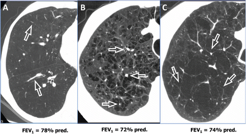 Figure 2. Exemplification of different COPD cases with a similar functional impairment but different radiological expression. (A) Patient with predominantly airway disease; (B) patient with centrilobular emphysema; and (C) patient with panlobular empysema. Open arrows indicate the most typical and suggestive lesion of the three different diseases. By courtesy of Claudio Tantucci, 2015. Respiratory Medicine Unit, Department of Clinical and Experimental Sciences, University of Brescia, Brescia, Italy.