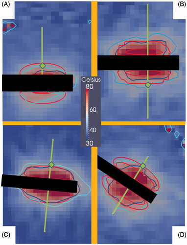 Figure 6. These images are MRTI from the four canine normal brain MRgLITT ablations. All images are from a slice that intersects the longitudinal axis of the laser applicator. Images A, B, C and D respectively correspond to canines 1, 2, 3 and 4 near maximum heating times t = 432 s, 222 s, 120 s, and 135 s. The superimposed green lines represent where the linear profiles for the four canines are plotted for Figures 4 and 5. Green diamonds indicate the location of temporal profiles in canine Figure 5. The black rectangles in each image are where the laser fibres were. The concentric red contours correspond to the predicted 60 °C isotherm contours with probabilities CDF = 2.3% and 97.7%. The areas between the red contours represent the central 95% of the model’s temperature distribution. According to the model, the CDF = 2.3% contour has a high probability of occurring, i.e. 97.7%. The dark blue and light blue contours respectively are the 60 °C isotherms from the MRTI temperature ±2σ of MRTI noise.