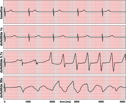 Figure 9. Electrocardiogram recordings for the baseline case and drug treatment with dofetilide at concentrations of 1x, 5.7x, and 30x. The baseline and dofetilide 1x electrocardiograms display regular periodic activation patterns at a heart rate of 60.15 beats per minute determined by the Purkinje fiber network. Dofetilide 1x prolongs the QT interval by 55% compared to baseline. The dofetilide 5.7x and 30x electrocardiograms display a regular depolarization during the first 50 ms, followed by a significant prolongation of the QT interval by 102% and 132%. Dofetilide 5.7x triggers the formation of U waves during the first two cycles, followed by a spontaneous transition into a sequence of rapid, widened irregular QRS complexes, a characteristic feature of torsades de pointes. Dofetilide 30x causes a complete loss of coordinated excitation.