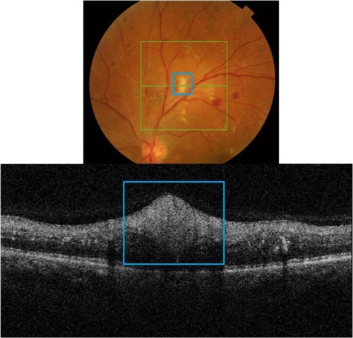 Figure 3 Fundus photograph (top) showing CWS (blue rectangle) in the left eye of a patient with diabetic retinopathy; the B-scan line on the fundus photograph has the same width as the B-scan SD-OCT image (bottom); SD-OCT image demonstrates thickened RNFL in CWS (blue rectangle).