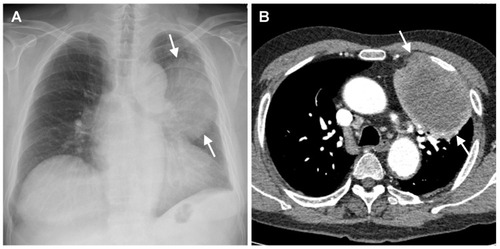 Figure 1 (A, B) The chest radiograph (A) and contrast-enhanced axial chest CT image with a mediastinal-window setting (B) obtained at our hospital showing a large mass (arrows in A and B) in the left upper lobe. The mass exhibits heterogeneous contrast enhancement with a central low-attenuation area. Note blunting of the left costophrenic angle secondary to left pleural thickening. There is no enlarged mediastinal or hilar lymph node.
