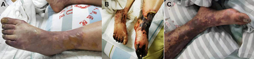 Figure 2 Cutaneous circumscribed ecchymosis and formation of bullae in Patient No.1 (A); gangrene in both lower extremities in Patient No.1 (B); extravasation of blood in the center of petechial lesions and enlargement of ecchymosis in Patient No.3 (C).