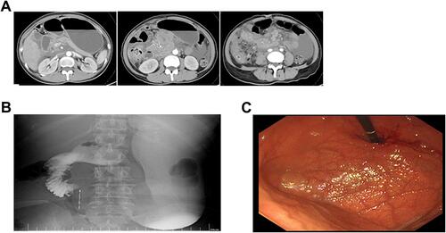 Figure 2 Radiological imaging studies and electronic gastroduodenoscopy showing progression of disease. (A) CT scan revealed that the gallbladder tumor lesion was larger than before and more lymph node metastases. (B) Upper gastrointestinal radiography showed obstruction at the origin of the horizontal part of the duodenum. (C) Electronic gastroduodenoscopy showed stenosis of the horizontal transition of the duodenum.
