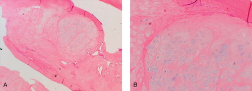 Figure 6. Low-power (A) and medium-power (B) photomicrographs showing the synovial chondromatosis. There is cartilaginous metaplasia within the synovial membrane. The cartilage shows evidence of proliferative activity, with large pleomorphic nuclei. These tend to be arranged in small bunches.