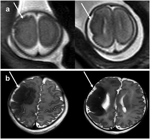 Figure 2. Prenatal and postnatal magnetic resonance pictures: (a) irregular surface of left frontal lobe with multiple small folds suggestive for polymicrogyria and abnormal thickening of cortex in the left parietal lobe at prenatal MRI (white arrow); (b) gyral cortical thickening and gyri separated by shallow sulci with hypointense signal and massive thickening of cortex in the left parietal lobe without intervening sulci at postnatal MRI (white arrow).