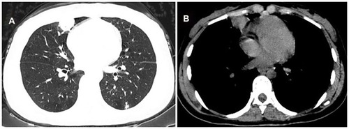 Figure 8 Case 5. CT findings in the right middle pulmonary lobe. (A and B) A 2.0cm×1.5cm irregular mass appeared after two months of anti-tuberculosis treatment.