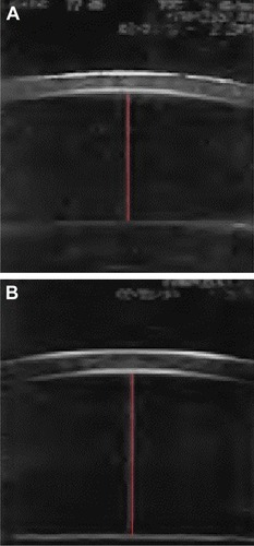 Figure 2 Anterior chamber depth (A) before and (B) after cataract surgery (red line extends from corneal endothelium to the anterior lens surface).
