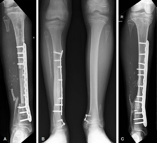 Figure 1. A. Postoperative image after Capanna procedure for CPT. B. 8-plates on both distal tibias to correct for ankle valgus at the donor and receptor sites. C. Cross-union between the distal anastomosis of graft and tibia and the remnant distal fibula.