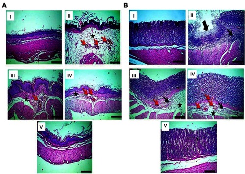 Figure 9 Histological examination (HE, 100x) of gastric tissues.Notes: (A) Non-glandular and (B) glandular gastric mucosa. (I) Normal control displaying an intact architecture of non-glandular and glandular gastric wall. (II) Positive control showing extensive congestion (red arrows) and edema (black asterisk) in non-glandular portion, mucosal ulceration (thick black arrow), and submucosal inflammation (thin black arrow) in glandular portion. (III)Rrats pretreated with diosmin (100 mg/kg) displaying moderate submucosal congestion (red arrows) and edema (black asterisk) in non-glandular and glandular portions besides submucosal inflammation (thin black arrow) in glandular portion. (IV) Rats pretreated with uncoated PLGA nanoparticles exhibiting mild submucosal congestion (red arrows) and edema (black asterisk) in non-glandular and glandular portions besides very mild submucosal inflammatory cells infiltration in glandular portion (thin black arrow). (V) Non-glandular and glandular gastric walls retained their normal histological pictures in rats pretreated with chitosan-coated nanoparticles.Abbreviation: PLGA, poly(d,l-lactide-co-glycolide).