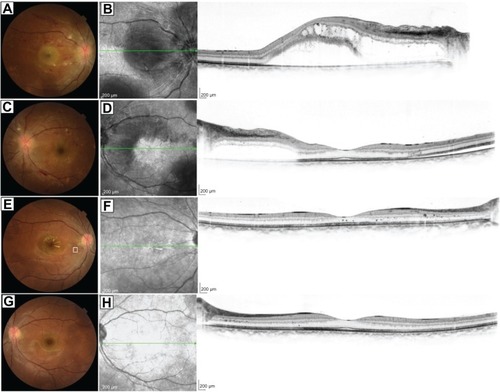 Figure 1 Fundus photographs and spectral-domain optical coherence tomography (SD-OCT) before and after treatment.