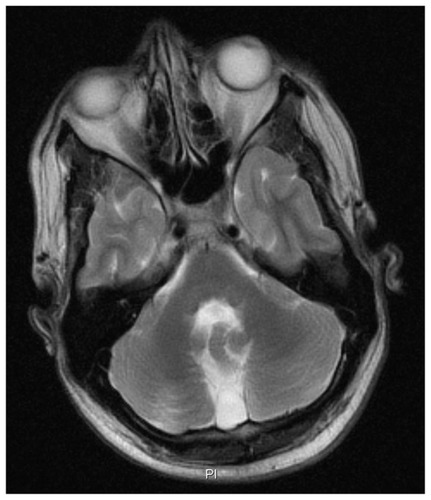Figure 2 Transversal T2-weighted magnetic resonance imaging of the brain of Patient 1, showing hypoplasia of the cerebellar vermis.