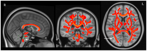Figure 2 TBSS analysis showing a significant difference in FA between patients with TBI and healthy controls. The TBSS analysis revealed significant differences between the group of patients with TBI and the healthy control group. The mean FA skeleton, which represents the centers of main white matter tracts, is shown in green. The white arrows indicate the FA skeleton. Overlaid on the skeleton are the results of the statistical analysis. Red and yellow represent significant differences (red, p-value < 0.05; yellow, p-value < 0.01). The group of patients with TBI exhibited a widespread decrease in FA compared with the healthy control group.