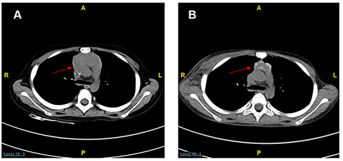 Figure 3 CT examination. Mediastinal mass was significantly decreased than before (A) after the chemotherapy (B) (red arrow).