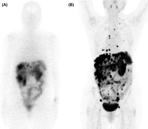 Figure 2. Comparison of the resolution between SRS and PET/CT. A 56-year-old woman with a small intestinal NET G2 since 10 years with known liver metastases and peritoneal carcinomatosis. In picture 2A, SRS depicts only liver metastases, while PET/CT with 68Ga-DOTATATE performed one month later, displayed in picture 2B, shows extensive supra- and infra-diaphragmatic lymph node involvement as well as pleural and bone metastases. During the time period between the investigations the patient had radiologically, biochemically and clinically stable disease.