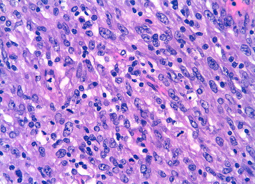 Figure 2. Histologic findings of prostatic sarcoma (HE, 400×). Atypical ovoid-spindle tumor cells with large vesicular nuclei and high mitotic index, accompanied by inflammatory cells.