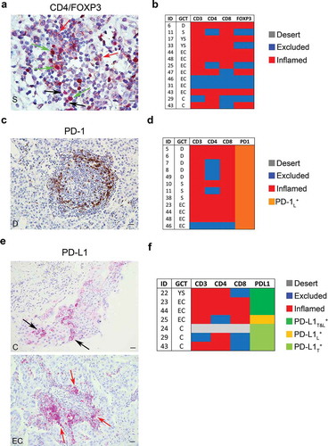 Figure 4. Density of FOXP3+, PD-1+ and PD-L1+ cells in meGCTs a, Representative IHC images of CD4 and FOXP3 double staining in primary meGCT samples visualized with diaminobenzidine (brown) and Fast Red (red), respectively. Red, black and green arrows indicate CD4+ cells, FOXP3+ cells and CD4+/FOXP3+ Tregs, respectively. Original magnification, x60. Scale bar, 30 µm. b, Distribution of TIL subsets in FOXP3-expressing meGCTs. c, Representative examples of PD-1+ cell staining in a meGCT samples. Original magnification, x20. Scale bar, 30 µm. d, Distribution of TIL subsets in PD-1-expressing meGCTs. e, Representative IHC images for PD-L1+ cell staining in primary meGCT samples. Black and red arrows indicate PD-L1+ tumor cells and tumor-infiltrating PD-L1+ lymphocytes, respectively. Original magnification, x20. Scale bar, 30 µm. f, Distribution of tumor-infiltrating T-cell subsets in PD-L1-expressing meGCTs. S, seminoma; D, dysgerminoma; YS, yolk sac tumors; EC, embryonal carcinoma; C, choriocarcinoma.