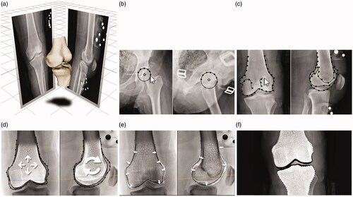 Figure 1. X-Atlas™ Imaging Technology Process. (a) A 3D scene representing the position of the patient relative to the source and image detector during x-ray acquisition is created. (b) The patient’s specific bony landmarks are defined on the AP and lateral images (e.g. femoral head). (c) The patient’s femoral and tibial bone contours are outlined on the AP and lateral images, which capture unique features of the patient’s bony anatomy. (d) A mean bone model for the femur and tibia is positioned and scaled in the 3D scene inside the patient-specific contours. (e) An automatic bone deformation is performed to match the 3D mean bone model to the patient-specific contours to fit the patient’s anatomy. (f) An estimated cartilage thickness is calculated (half distance between bones on a weight-bearing AP x-ray) and applied to the femoral and tibial bones. Dotted line: Patient’s bone contour; Solid line: Projected mean bone contour; Dashed line: Deformed bone contour; Black area (distal end of bones): Added cartilage.